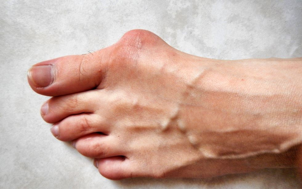 Hallux valgus oignon