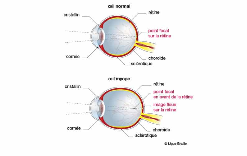 shéma oeil myope oeil normal