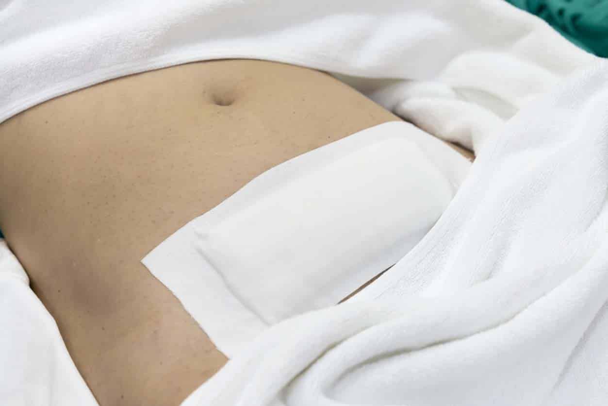 Après avoir chirurgie hystérectomie par laparotomic myomectomie, patiente donné pansements imperméables pour les points