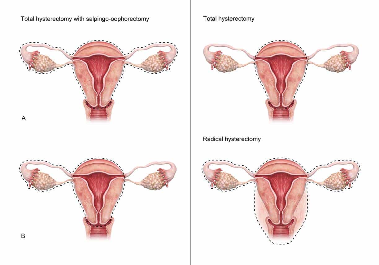 Types Of The Hysterectomy