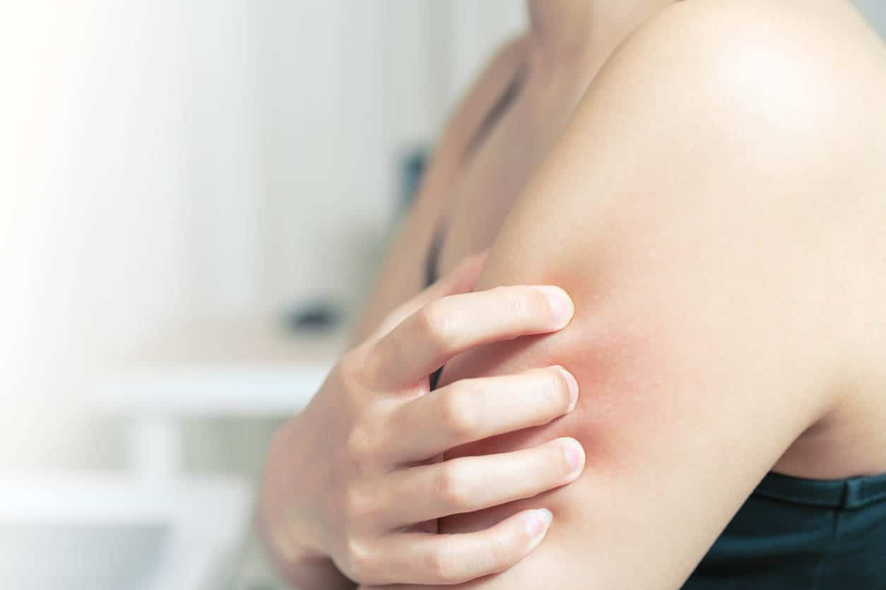 Women Hand Scratch The Itch On Arm, Healthcare And Medicine Concept.