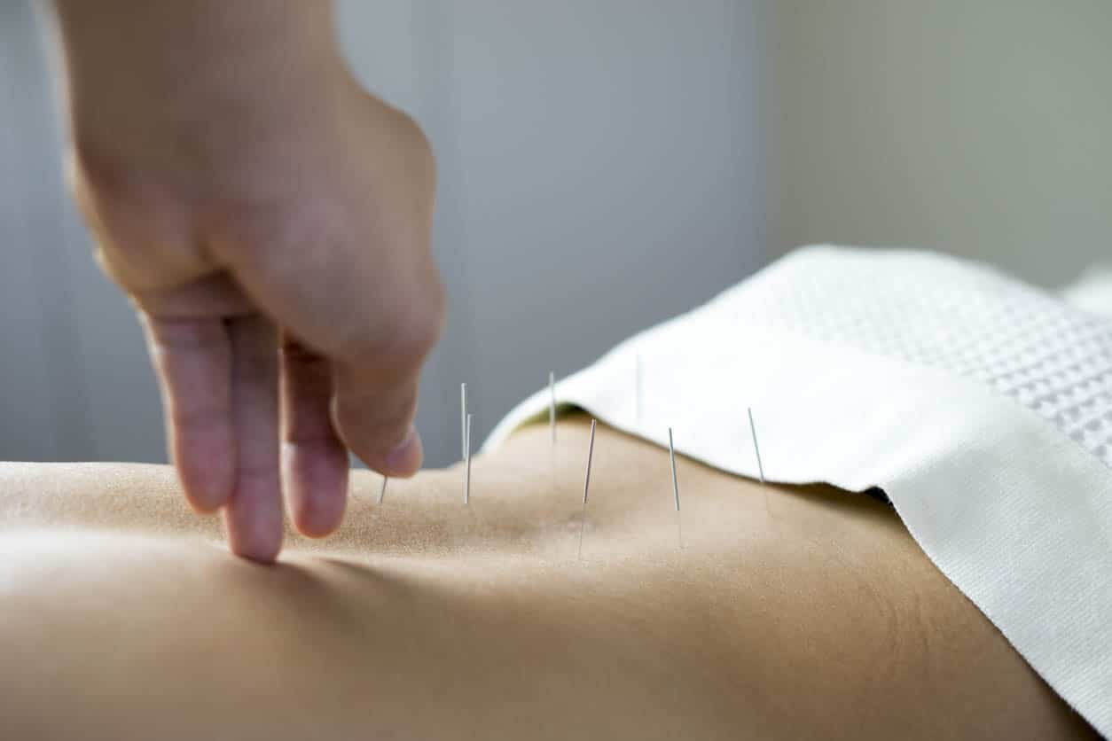 traitement Acupuncture sur le dos