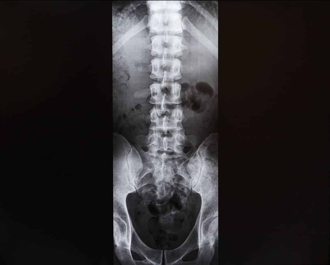 radiographie colonne vertebrale