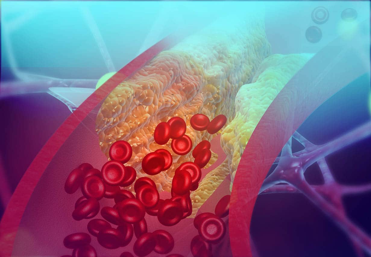 Artère de blocage de cholestérol 