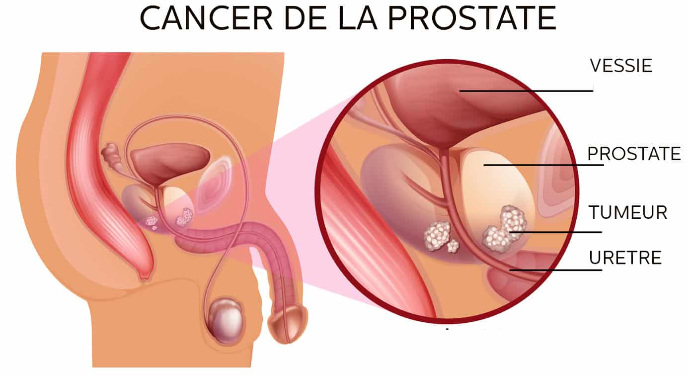 shema cancer de la prostate