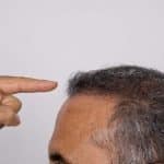 Six mois après cheveux implant capillaire