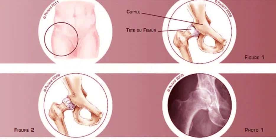Chirurgie Hanche Shema 1