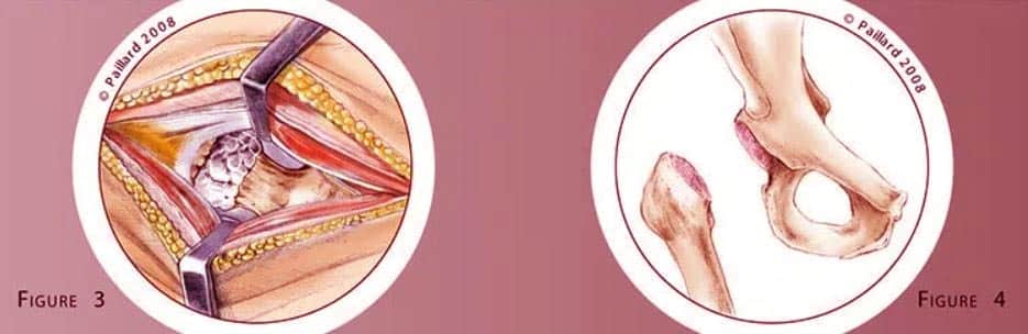 Chirurgie Hanche Shema 2