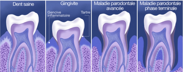 Shema Parodontologie Soins Des Gencives