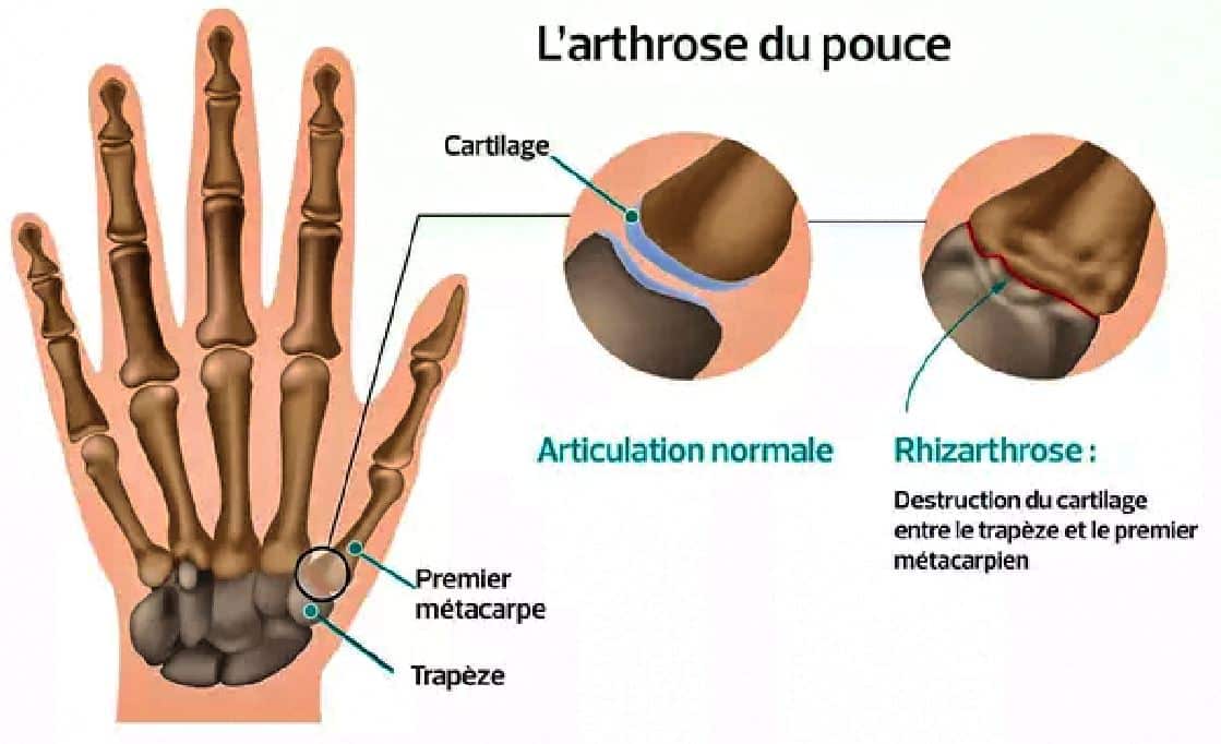 Shema Arthrose Du Pouce